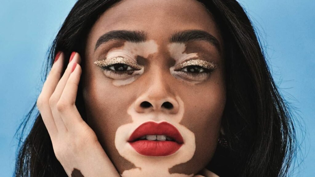 winnie harlow